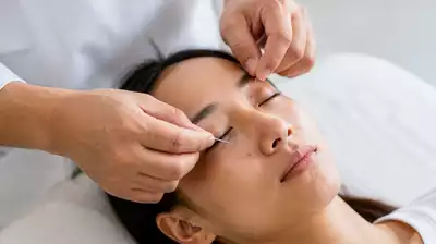 Patient receiving acupuncture treatment for eyes